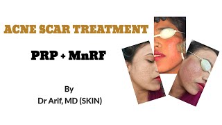 Acne Scar treatment by PRP+MnRF @Designerdoc  #Acnescartreatment || DERMATOLOGIST