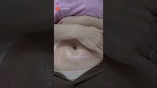 AFTER DERMA STRETCH MARK - BUAT KALIAN YANG MAU DERMAPEN STRETCH MARK, WAJIB NONTON INI