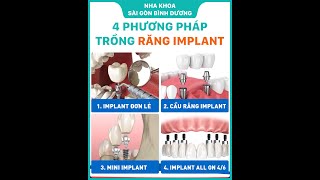 💥TRỒNG RĂNG IMPLANT - MẤT RĂNG KHÔNG CÒN LÀ NỖI LO