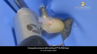 Composite removal with LiteTouch™ Er:YAG laser