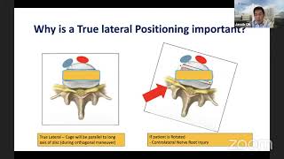 Oblique Lumbar Interbody Fusion: Tips and Tricks