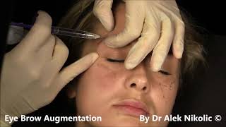 Eye Brow Augmentation