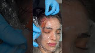 beauty is pain but PRP is worth the results #prp #facial