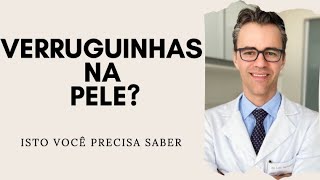 VERRUGUINHAS na pele? Isto você precisa saber | Por Luiz Gameiro, dermatologista