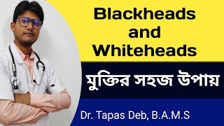 How to get rid of Blackheads and Whiteheads| Dr. Tapas Deb| Home Remedies