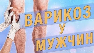 Варикоз у мужчин. Чем отличается от варикоза у женщин?