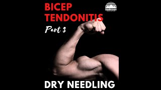 Bicep Tendonitis - DRY NEEDLING