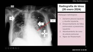 Tres casos de TEP en Hospital Loayza