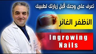 Ingrowing Nail - الأظفر الغائر