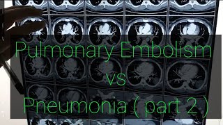 Pulmonary Embolism vs Pneumonia ( part 2 )