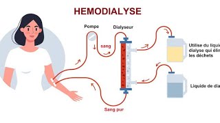 Néphrologie : Les critères d'une dialyse (’épuration extra rénale) en urgence