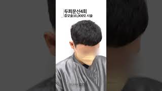 엠자/정수리탈모 말기, 두피문신과 헤어증모술로 크롭컷 스타일