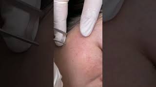 Laser melasma treatment