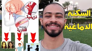 السكتة الدماغية (اعراض، اسباب، تشخيص، علاج) - Stroke