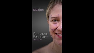 Ponytail Facelift and Revision Rhinoplasty - Aesthetic Facial Plastic Surgery Pre-op Consultation