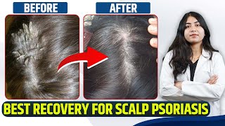 5 महीने में स्कैल्प सोरायसिस हुआ ठीक | Scalp psoriasis removal satisfying | Scalp ka ilaj