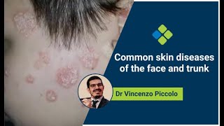 Common skin diseases of the face and trunk | Dr Vincenzo Piccolo