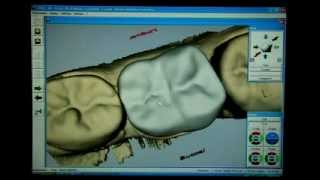 CEREC Techniques