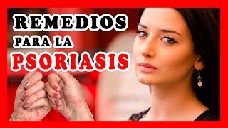 Como tratar la psoriasis en el cuero cabelludo y otras partes | Remedios caseros para la psoriasis