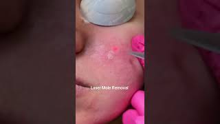 Laser mole removal treatment all skin types#glowingskin#beauty#laserskinrejuvenation#facial