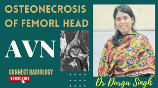 OSTEONECROSIS OF FEMORAL HEAD ( AVASCULAR NECROSIS OF FEMORAL HEAD ~ AVN )