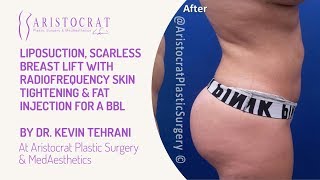 Liposuction Skin Tightening & Fat Injection for a BBL Long Island, New York by Dr. Kevin Tehrani