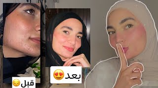 مكون واحد صفالي بشرتي وخلصني من كل الحبوب😍☝🏻 فيديو مهممم