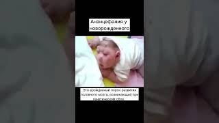 Это тяжелый порок развития головного мозга #анэнцефалия #порокразвития