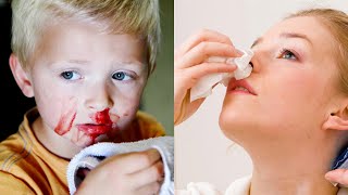 Symptoms of nosebleeds and its treatment. #treatment #nose #nosebleeds #خون