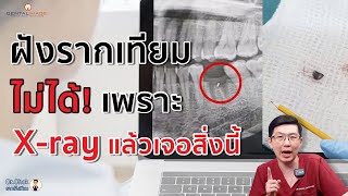 ฝังรากเทียมไม่ได้! เพราะ X-ray แล้วเจอสิ่งนี้! | หมอโชคมีคำตอบ Dentalimage