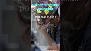 Carbon monoxide poisoning │ Selected medical terminology │ #medicalterminology #COpoisoning #short