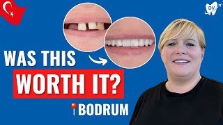 Dental Implants in Bodrum, Turkey: An Irish Patient's Honest Review!