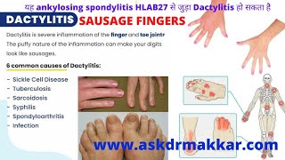 Dactylitis?Sausage fingers realated  Autoimmune disease HLA-B27 Causes?Symptoms?Homeopathic Medicine