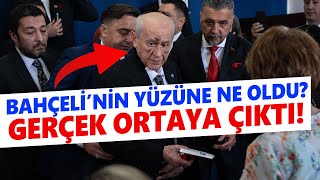 Bahçeli'nin yüzüne ne oldu? Suratındaki morlukların nedeni ne? Gerçek ortaya çıktı