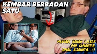 Kelainan genetik, dengan badan satu untuk berdua, ini yang terjadi pada mereka berdua