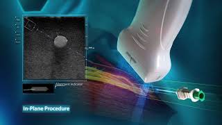 eSpacial iNavi Needle Guided Injection