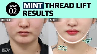 [Korea Plastic Surgery Review] Thread lifting Results | V.LIF Plastic Surgery Clinic