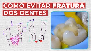 COMO EVITAR FRATURA DOS SEUS DENTES - Mylene e Renato