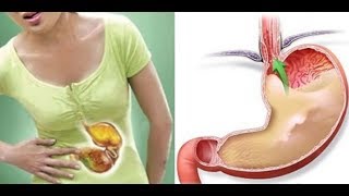 Symptoms Of Acid Reflux And Simple Solutions To Avoid It