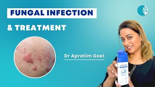 Get relief from excess sweat and itch Use Abzorb Dusting Powder Daily | Dr Apratim Goel