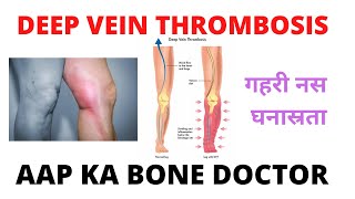 DEEP VEIN THROMBOSIS - EPISODE 44