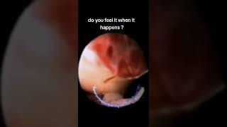 Live human ovulation