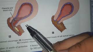 Threatened Miscarriage, Inevitable, Complete, Incomplete and Missed Miscarriage