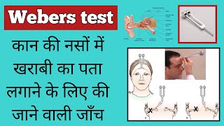 webers test | rinne test | sensorineural hearing loss