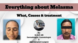 Everything about melasma/झाईयो की पूरी जानकारी @designerdoc #Melasmatreatment #Melasma