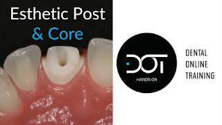 Online CE: Dental Post Cementation and Core Build-Up with Dr. Dennis Hartlieb