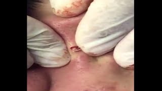 Acne clear - Blackhead removal - Beauty care video #13