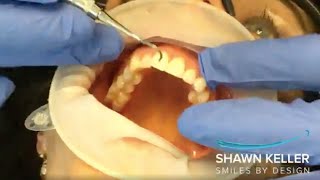 Non-Metal Dental Implants — Alternative To Root Canals