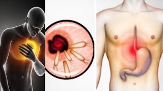 HOW TO GET RID OF THIS BACTERIA CAUSING YOU BLOATING, HEARTBURN, REFLUX, DIARRHEA, AND OTHER SYMPTOM