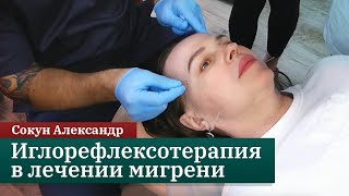 Иглорефлексотерапия в лечении мигрени. Сокун Александр